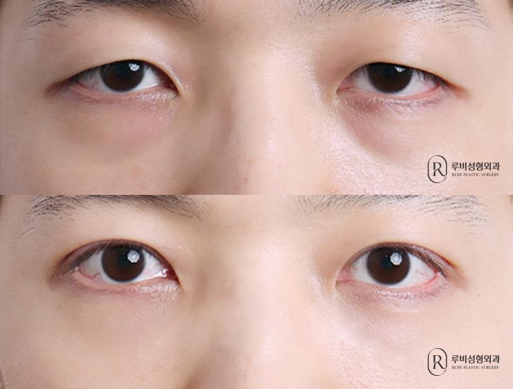 남자 자연유착, 눈매교정, 눈밑지방재배치