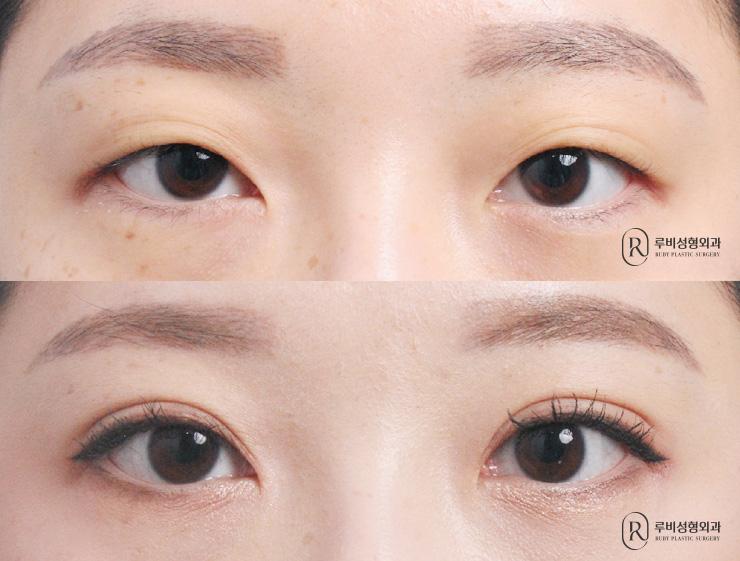 Natural adhesion, ptosis correction