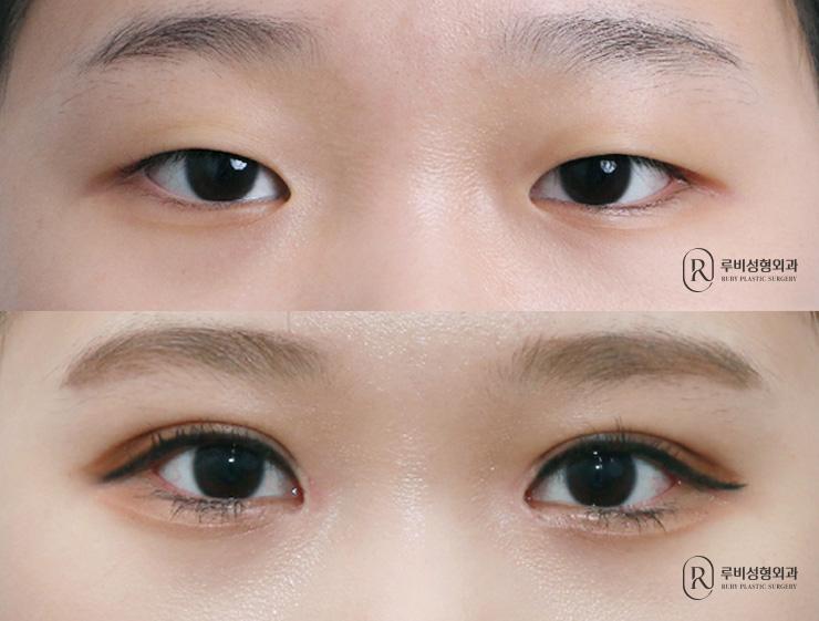 Incisional, ptosis correction, epicanthoplasty