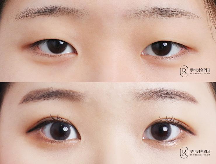 Natural adhesion, ptosis correction