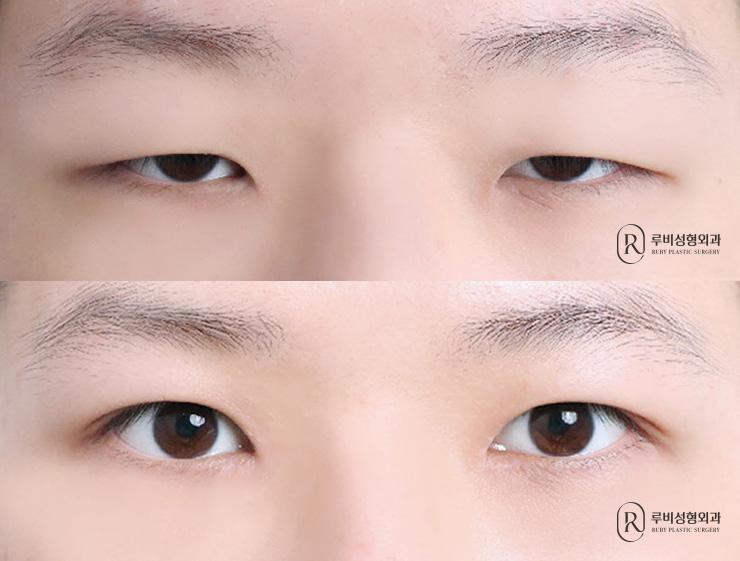남자 자연유착, 눈매교정, 앞트임