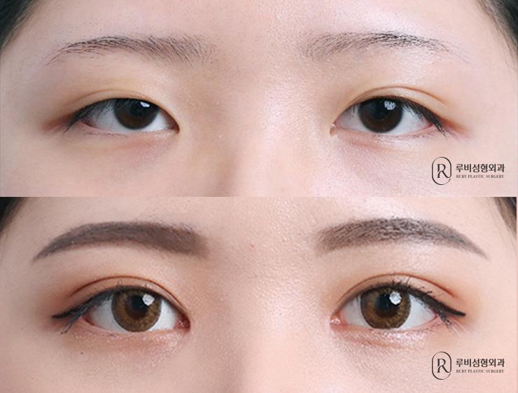 자연유착, 눈매교정, 앞트임