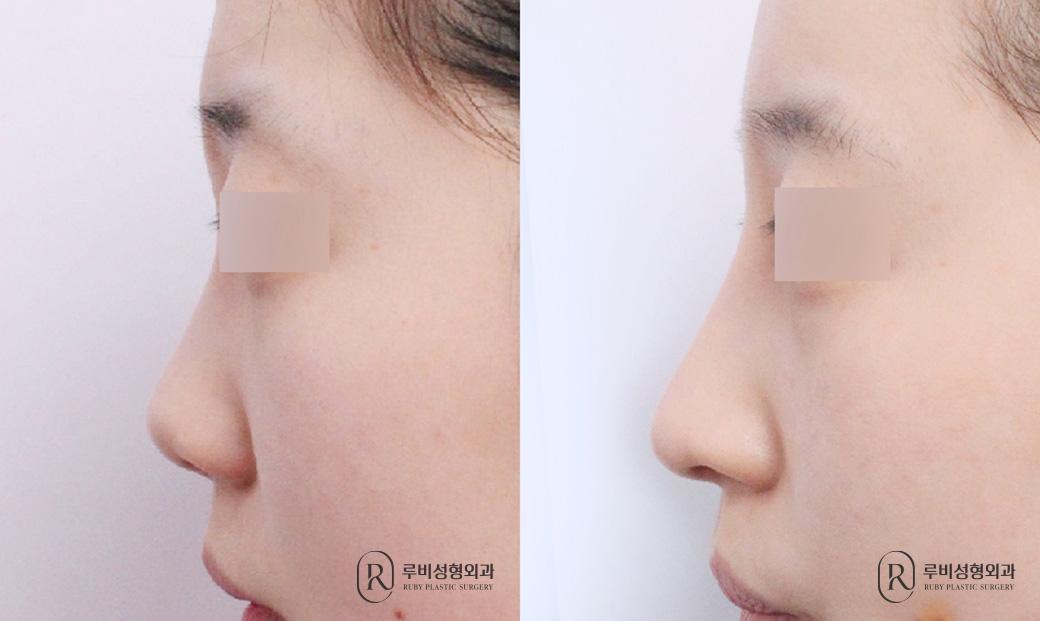 Nasal bridge, nasal tip, short nose correction