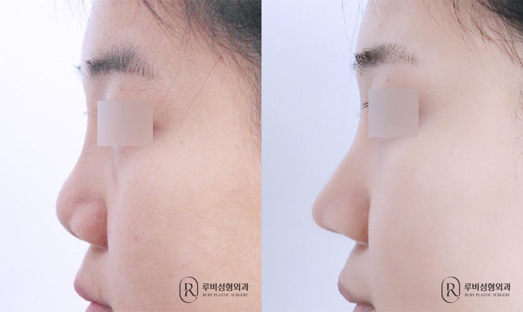 Nasal bridge, nasal tip, donor cartilage, short nose correction, revision surgery