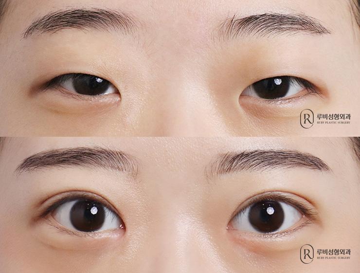 Natural adhesion, ptosis correction