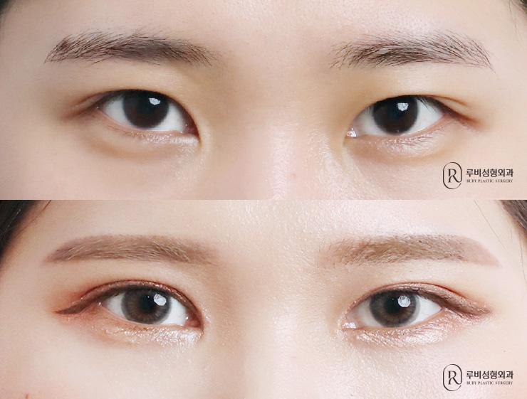 Natural adhesion, ptosis correction, epicanthoplasty