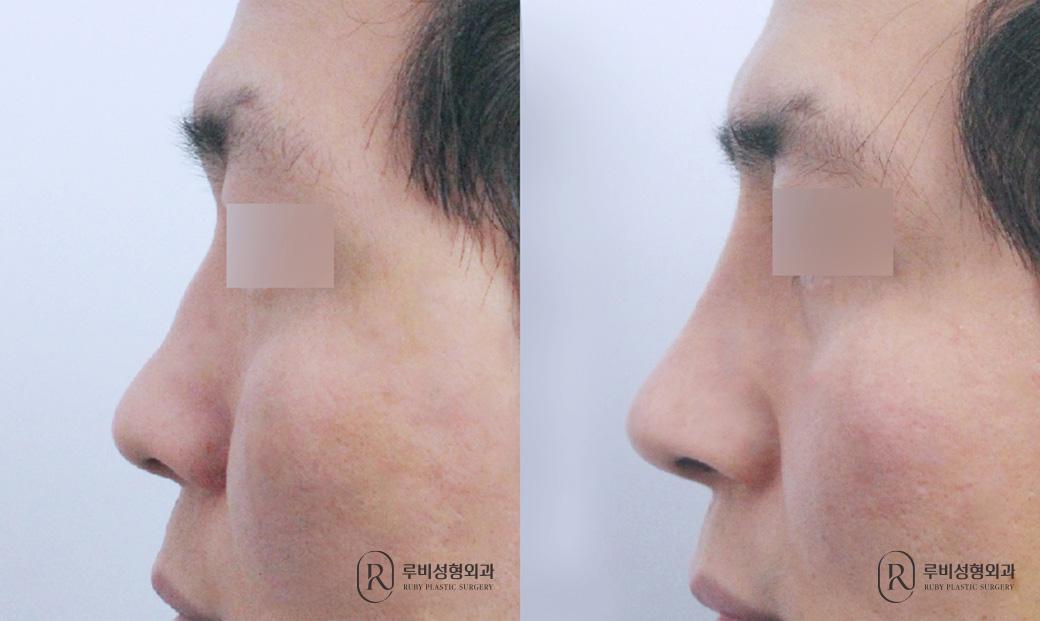 Nose bridge, nose tip, humpectomy, deviated nose