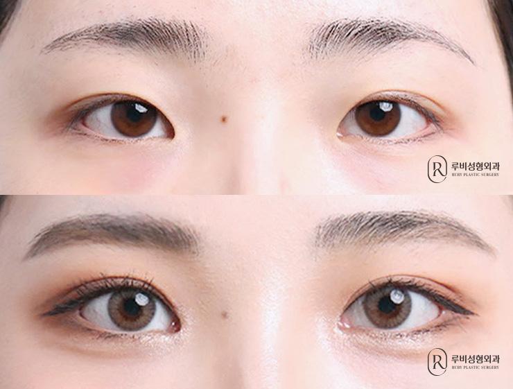 자연유착, 눈매교정, 앞트임
