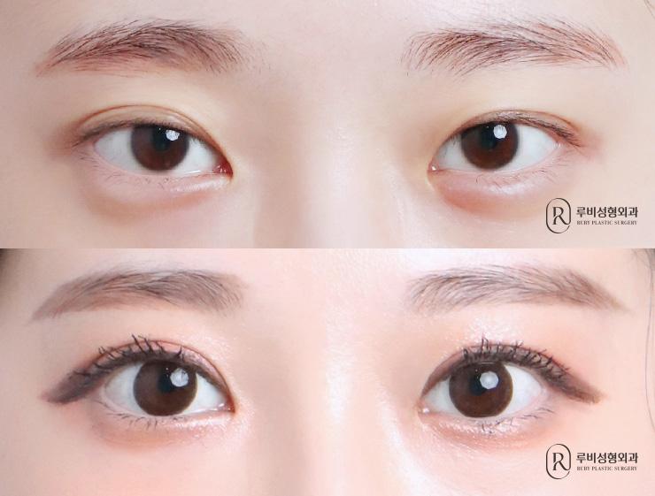 Natural adhesion, ptosis correction