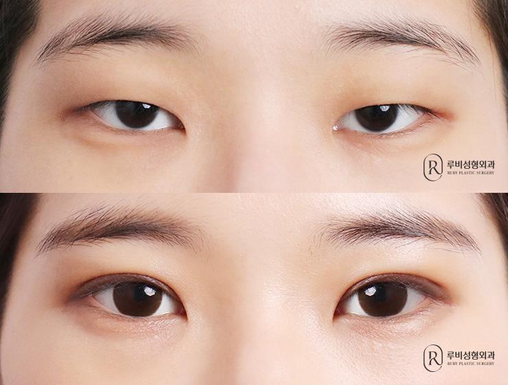 Natural adhesion, ptosis correction