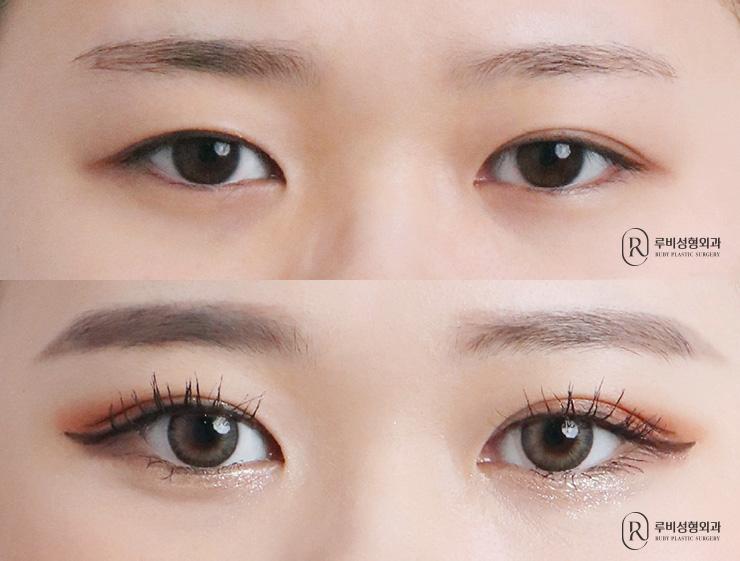 Natural adhesion, ptosis correction