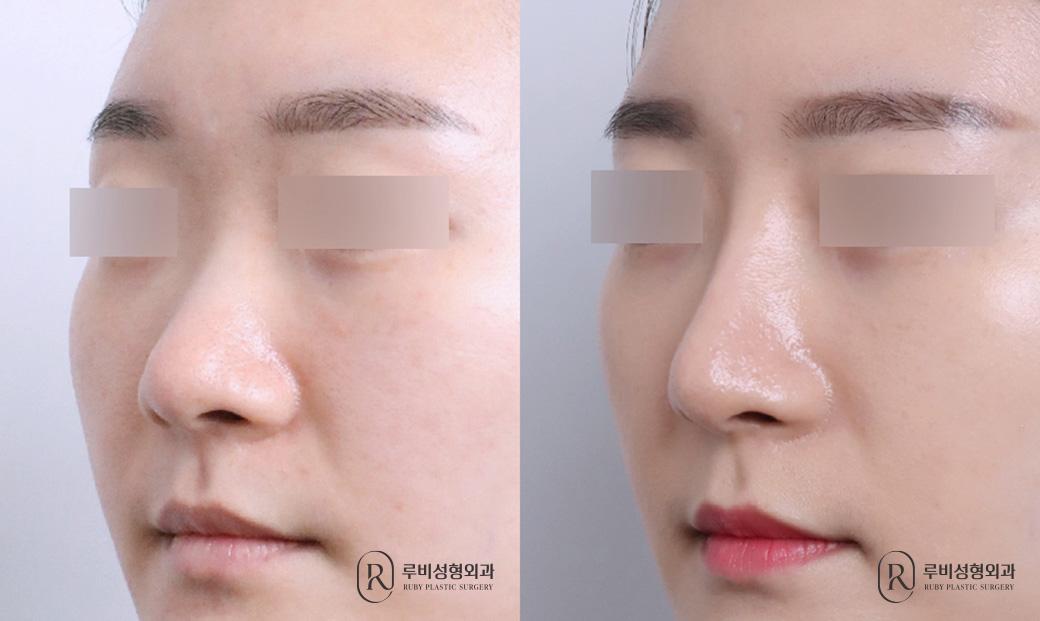 Nasal bridge, nasal tip, short nose correction, alar cinching