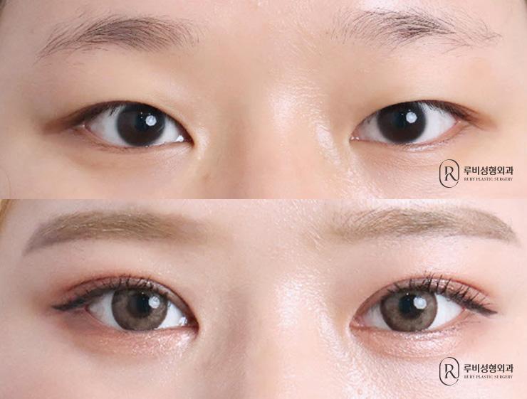 눈성형
