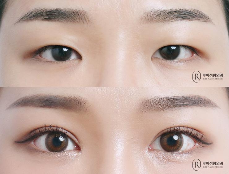 Natural adhesion, ptosis correction, epicanthoplasty