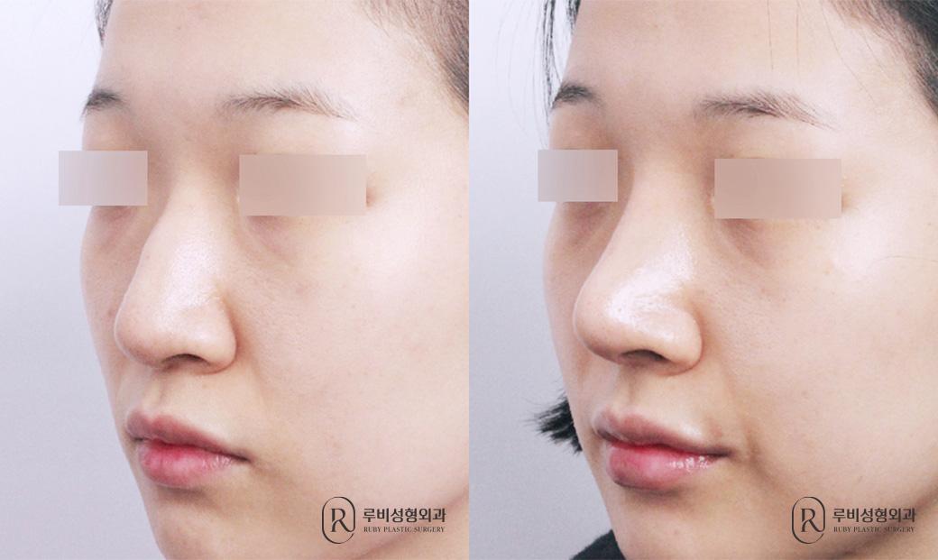 Nasal bridge, nasal tip, short nose correction, alar cinching