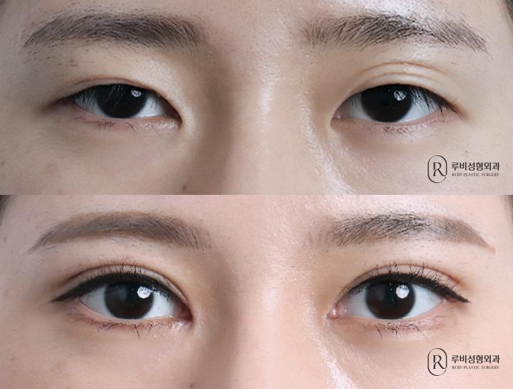 자연유착, 눈매교정, 앞트임, 재수술