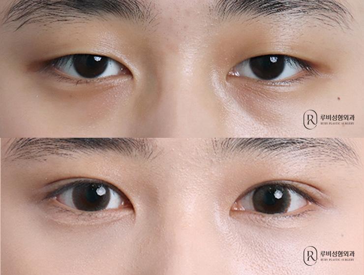 자연유착, 눈매교정, 눈밑지방재배치