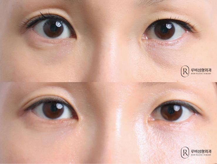 Eye Bag Reposition