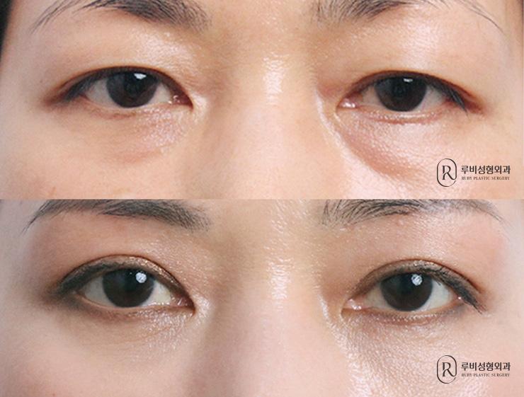 Brow lift, natural adhesion, ptosis correction, Eye Bag Reposition