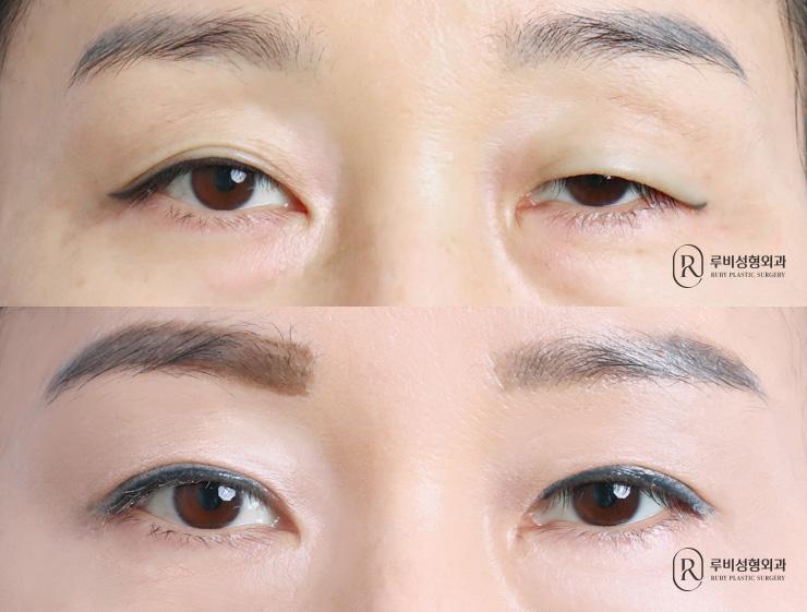 Brow lift, natural adhesion, ptosis correction
