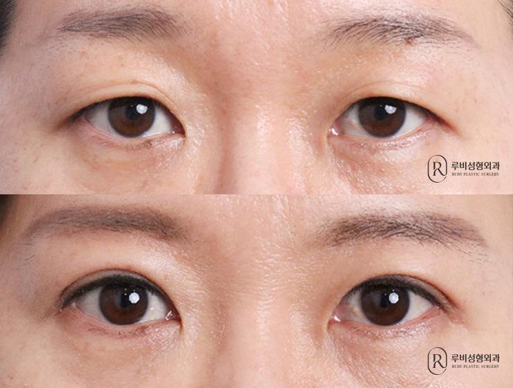 Brow lift, natural adhesion, ptosis correction