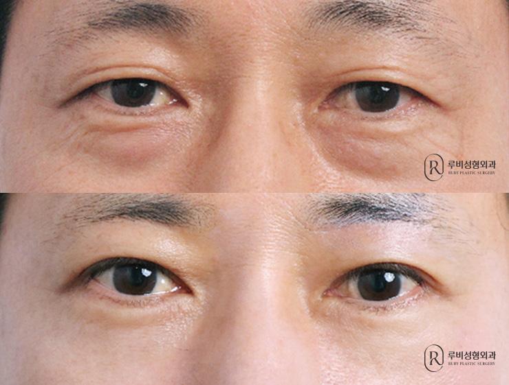 Men's brow lift, natural adhesion, ptosis correction, Eye Bag Reposition