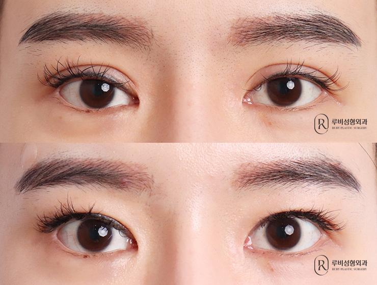 Incisional, ptosis correction