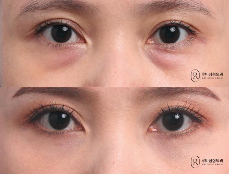 Eye Bag Reposition