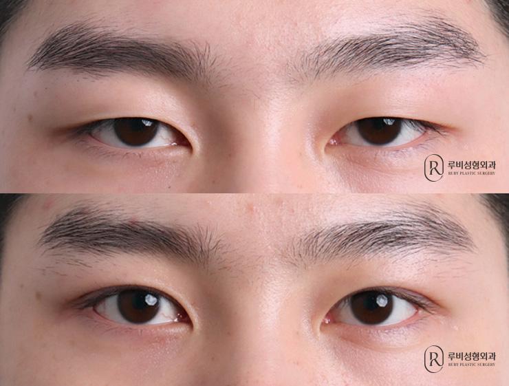 남자 자연유착, 눈매교정