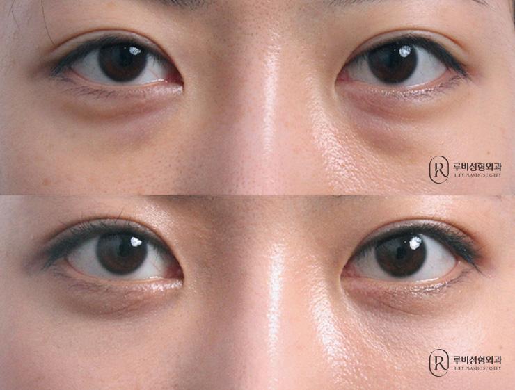 Eye Bag Reposition