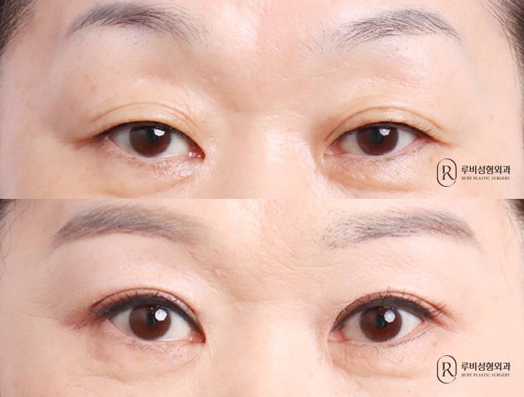 Brow lift, natural adhesion, ptosis correction