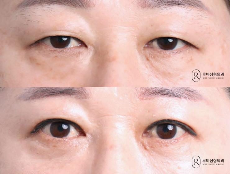 Brow lift, natural adhesion, ptosis correction, Eye Bag Reposition