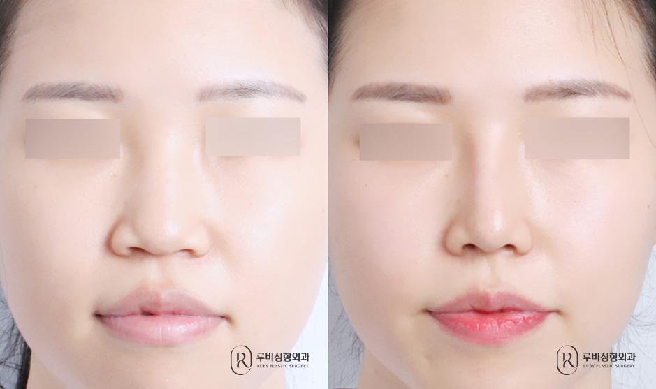 Nose bridge, nose tip, humpectomy, nose revision, alar cinching