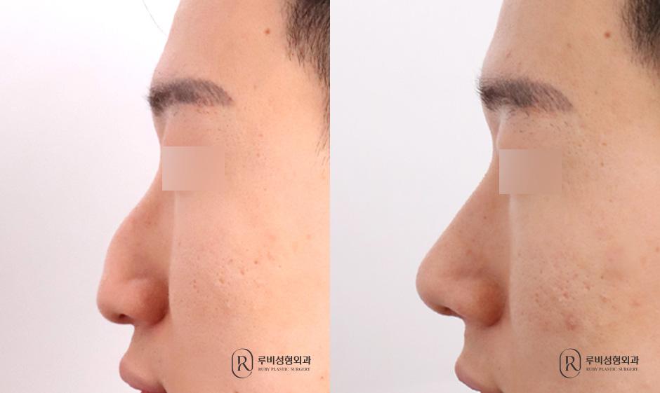 Nose bridge, nose tip, humpectomy, long nose correction