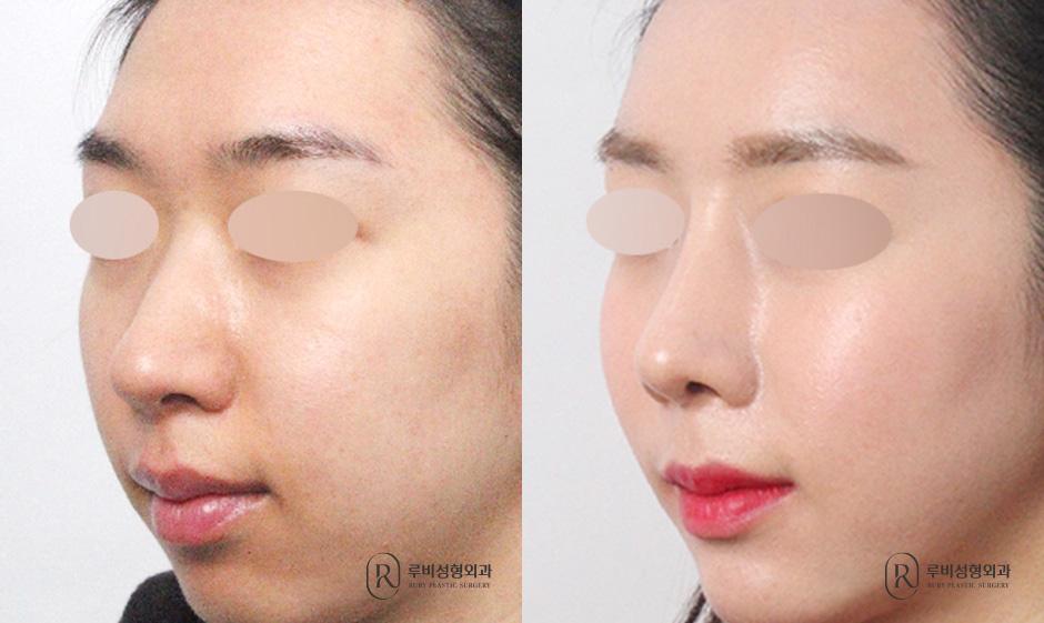 Nose bridge, nose tip, humpectomy, long nose correction, bulbous nose correction