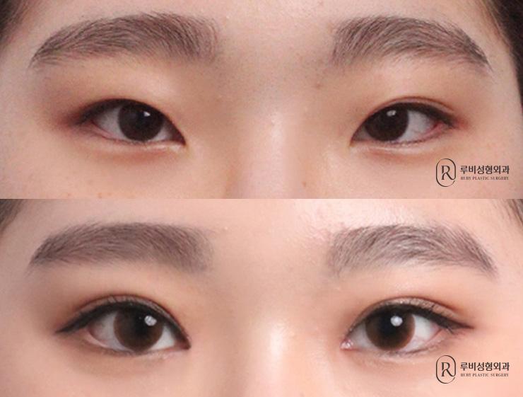 Natural adhesion, ptosis correction, medial, lateral and lower canthoplasty