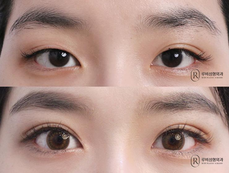 Natural adhesion, ptosis correction, revision surgery