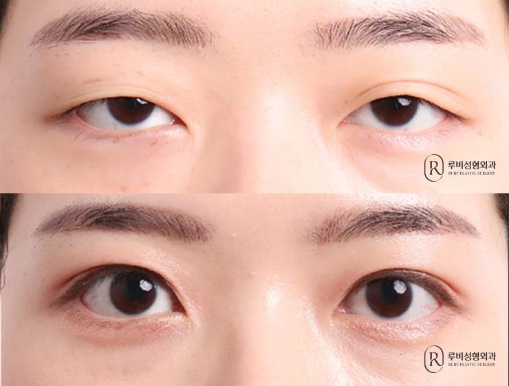 Natural adhesion, ptosis correction