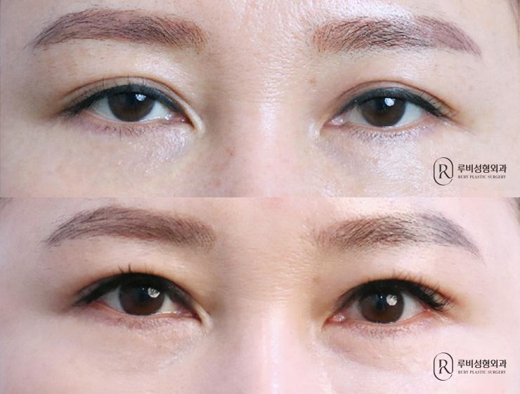 Natural adhesion, ptosis correction