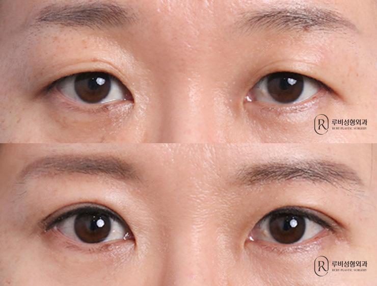 Brow lift, natural adhesion, ptosis correction