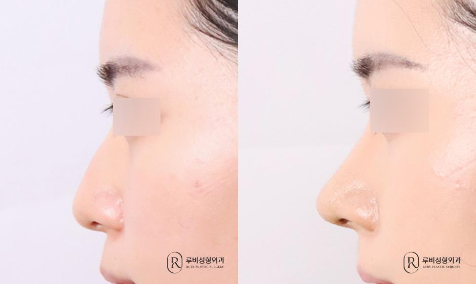 Nose bridge, nose tip, humpectomy, long nose correction