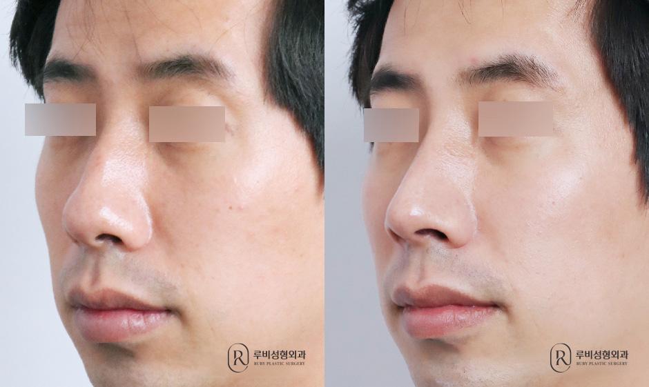 Nose bridge, nose tip, humpectomy
