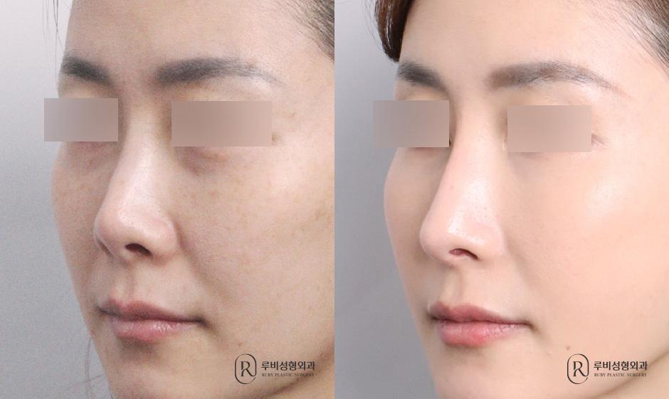 Nasal bridge, nasal tip, short nose correction, revision surgery