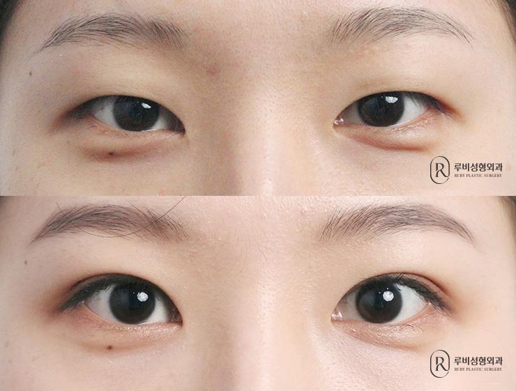 Natural adhesion, ptosis correction