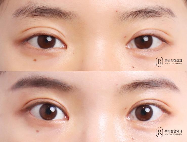 Natural adhesion, ptosis correction, revision surgery