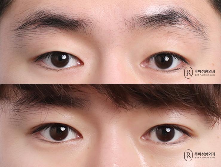 Men's natural adhesion, ptosis correction