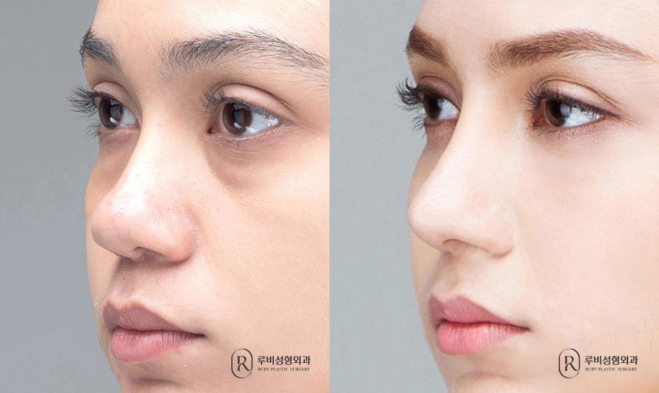 Nasal bridge, nasal tip, bulbous nose correction