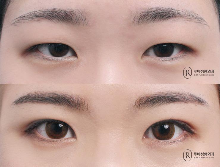 Natural adhesion, ptosis correction