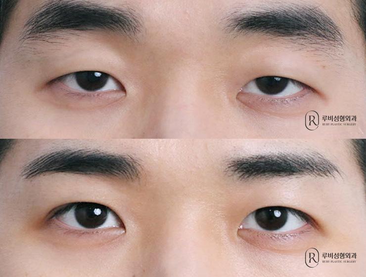 Men's natural adhesion, ptosis correction, lateral canthoplasty