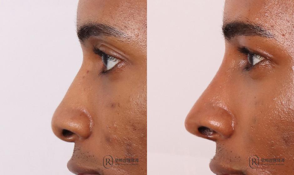 Nose bridge, nose tip, humpectomy, alar cinching, long nose correction